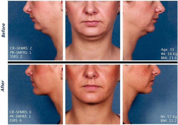 Kybella Injections for Double Chin Reduction Before After Pictures