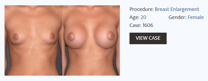 breast augmentation before and after - Dr Fiala
