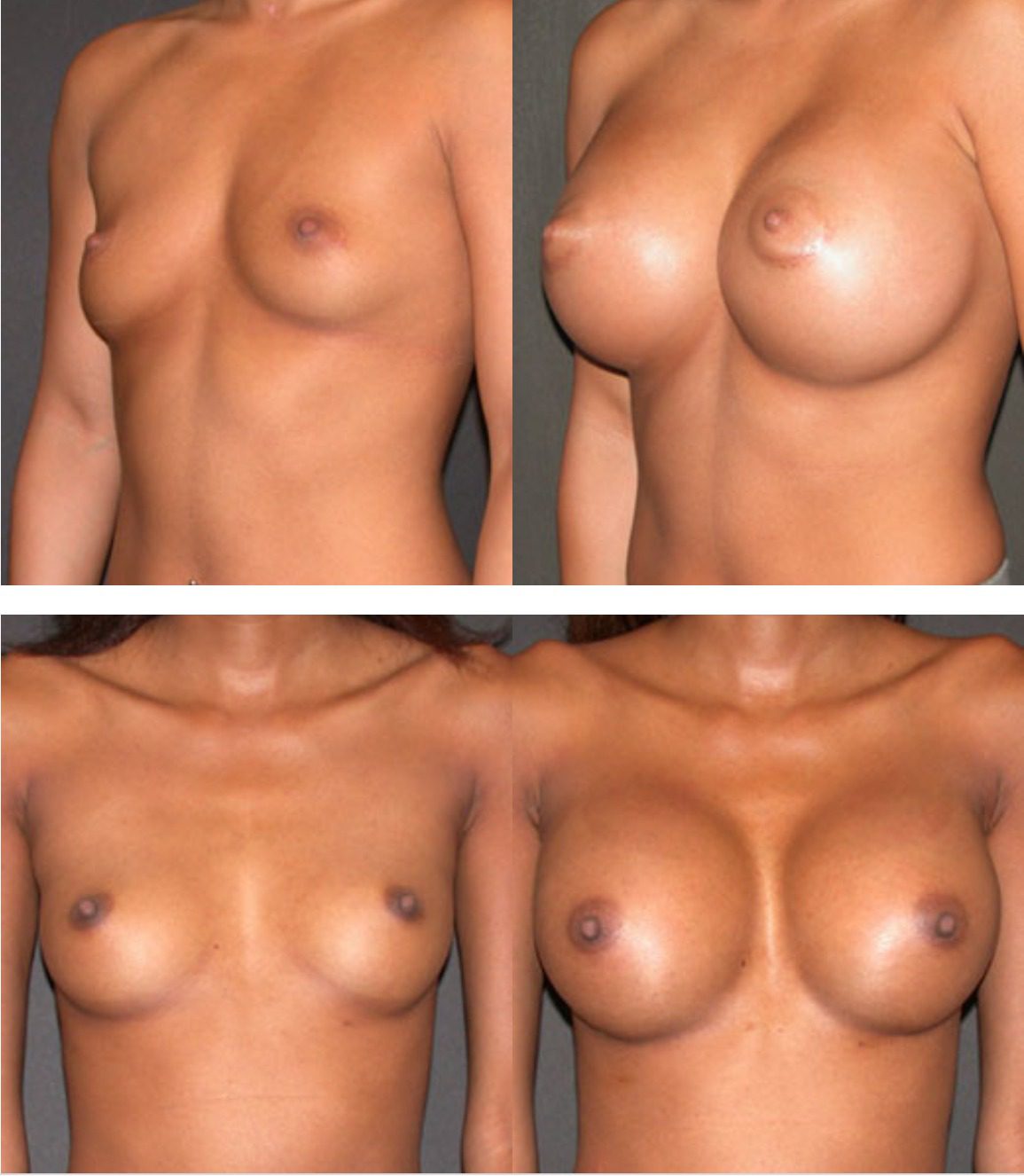 Breast Augmentation Surgery Orlando Florida Best Plastic Sur