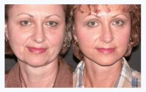 Face Lift before and after photo | Fiala Aesthetics