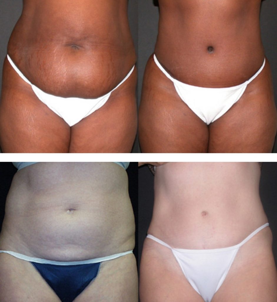 Tummy Tuck Recovery and Follow Up - Tampa Palms Plastic Surgery