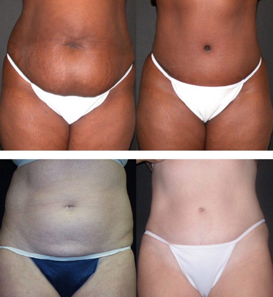 Tummy Tuck Before After Photos  Orlando Florida Best Plastic Surgeon