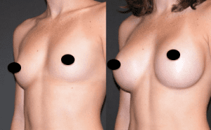 Before and After patient photo breast augmentation | Fiala Aesthetics