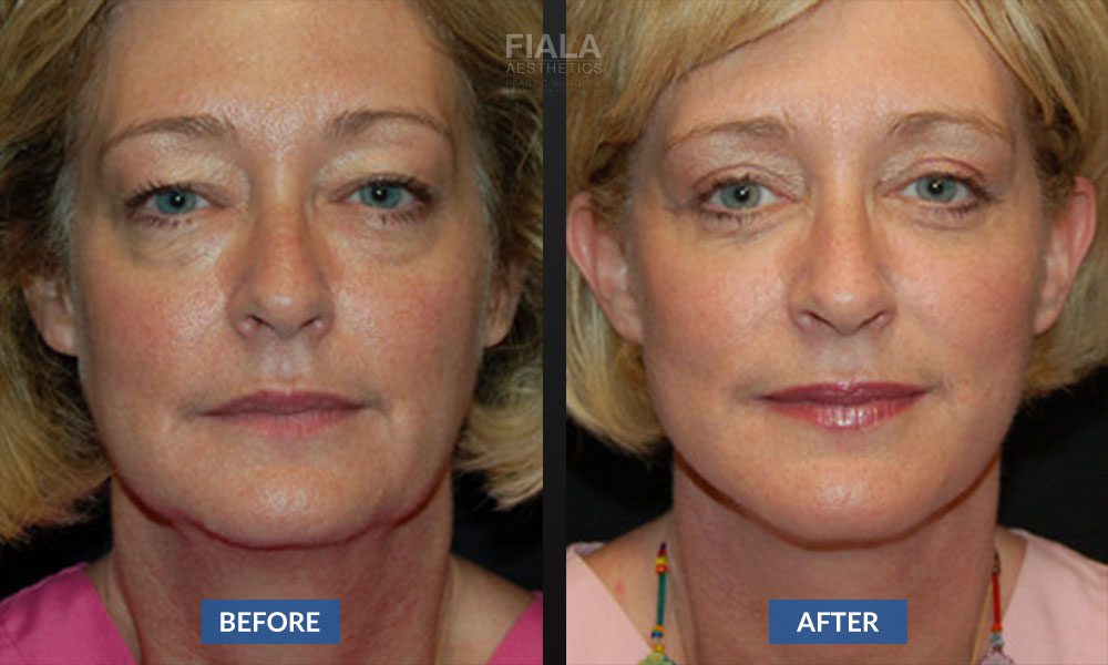 Facelift Before & After | Fiala Aesthetics