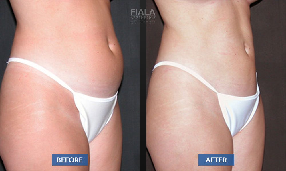 Liposuction before and after | Fiala Aesthetics