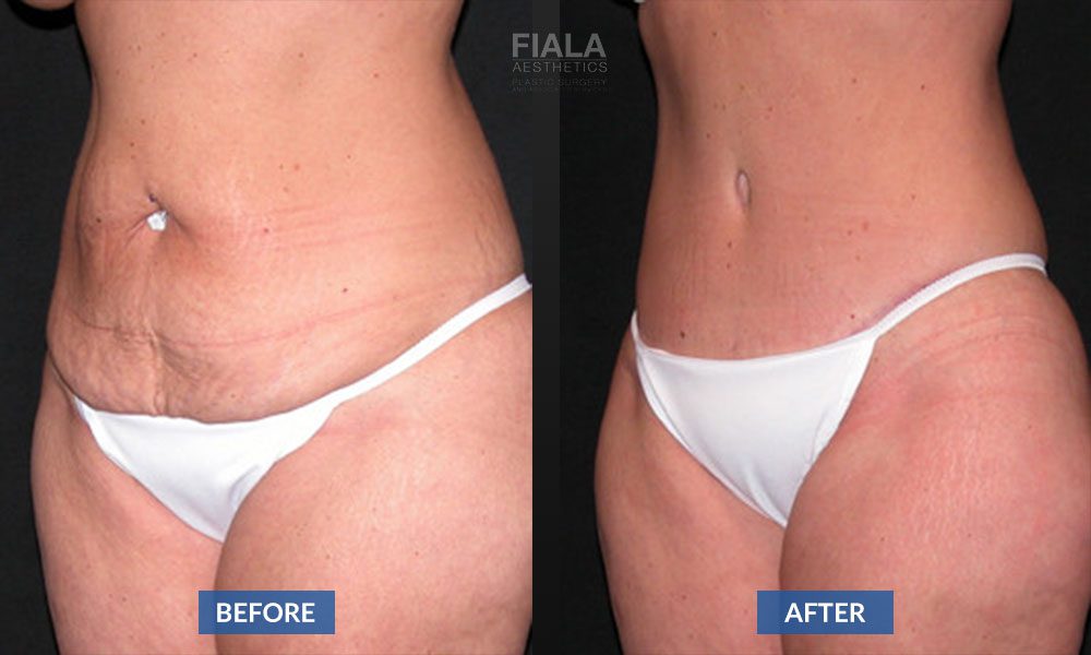 Tummy Tuck Before and After | Fiala Aesthetics