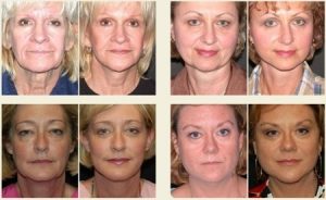 Facelifts: Before & After