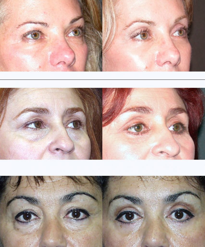 Eyelid Lift Before & After | Fiala Aesthetics