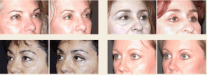 Blepharoplasty | Eyelid Surgery Before After Photos | Altamonte Springs FL