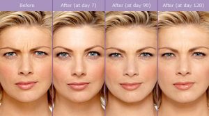 Botox Injections by Board Certified Plastic Surgeon Dr Fiala Orlando Florida