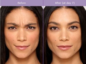 How Long Does Botox Last | Anti-Aging | Orlando |Plastic Surgery