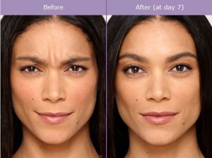 Botulinum Toxin (Botox) Procedure Steps | Orlando Medical Spa