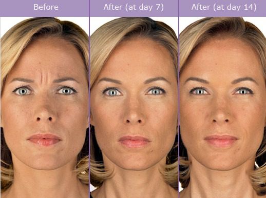 Botox Before and After Pictures