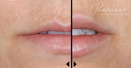 Restylane Lip Injection Dermal Filler Before and After Photo