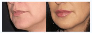 Injectable fillers - lips - Fiala Aesthetics