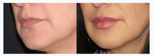 Injectable fillers - lips - Fiala Aesthetics