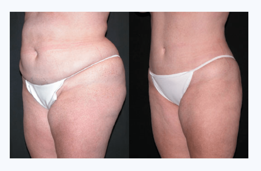 Body LIft Before & After - Dr Fiala