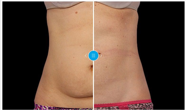 CoolSculpting abdomen treatment before and after