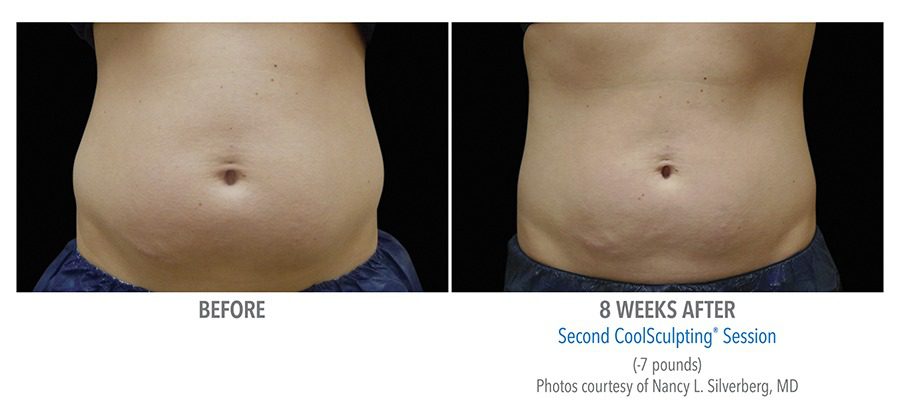 CoolSculpting FAQ, Fiala Aesthetics Orlando, Windermere