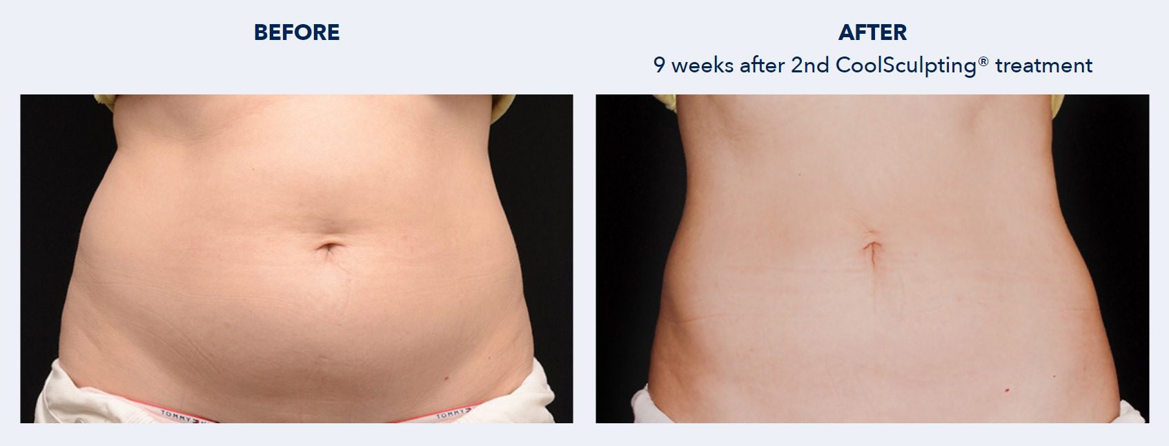 CoolSculpting Before and After Patient Results 1