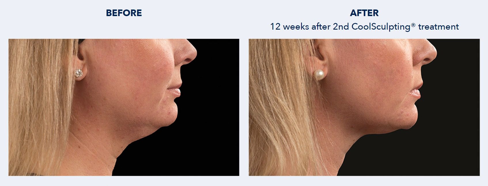 CoolSculpting Before and After Patient Results 4