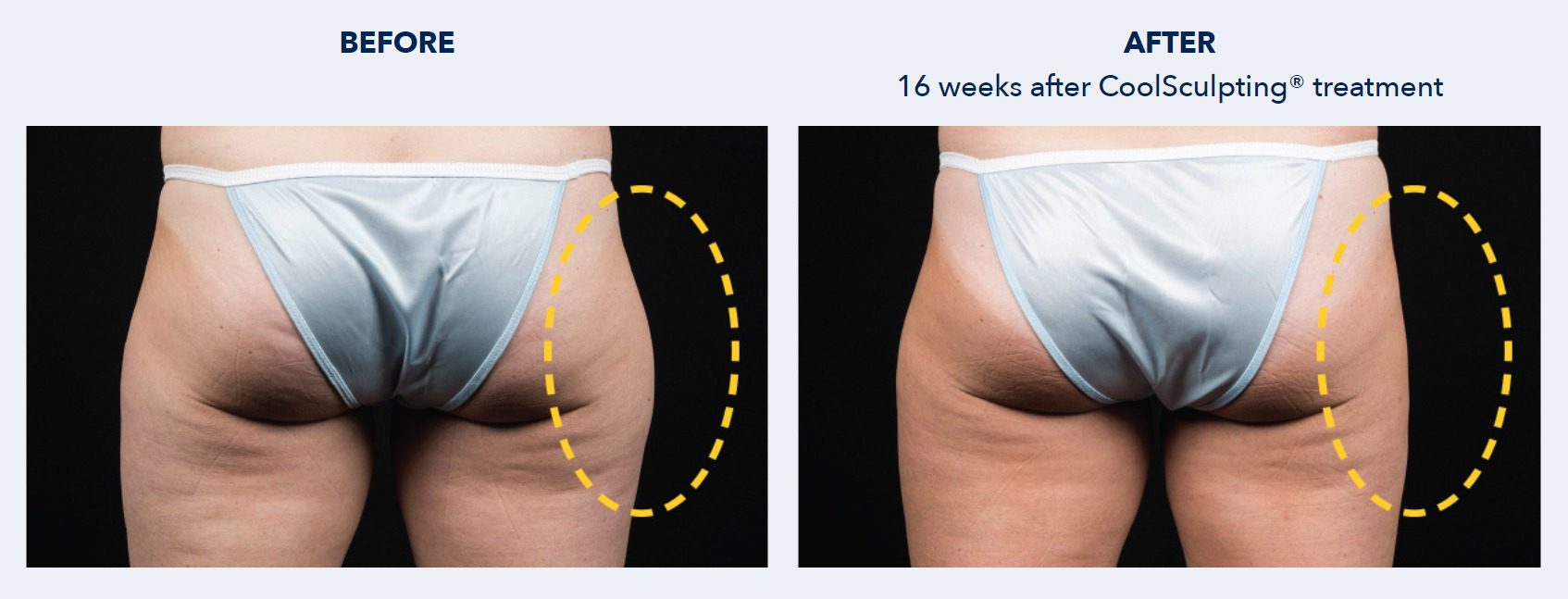 CoolSculpting Before and After Patient Results 3