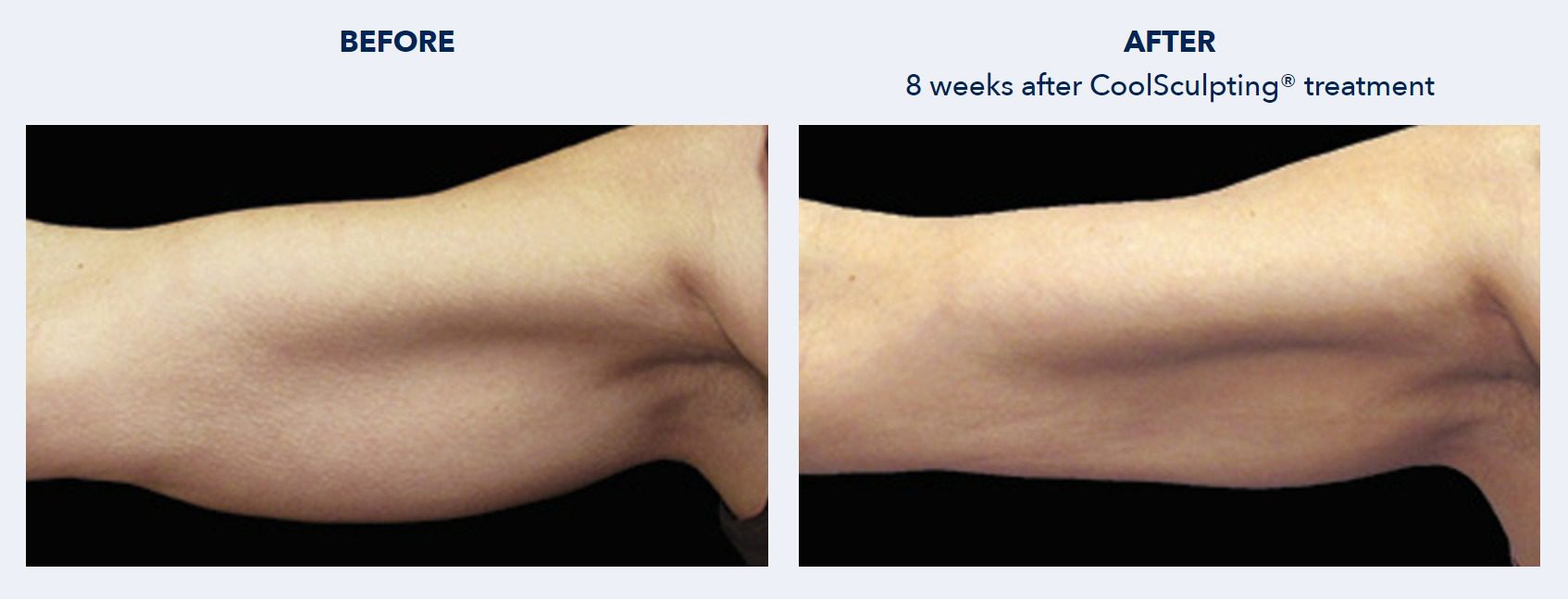 CoolSculpting Before and After Patient Results 6