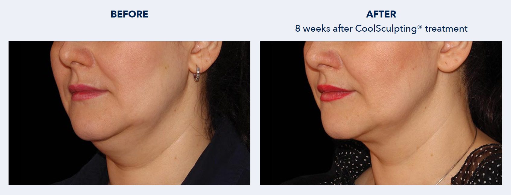 CoolSculpting Before and After Patient Results 5