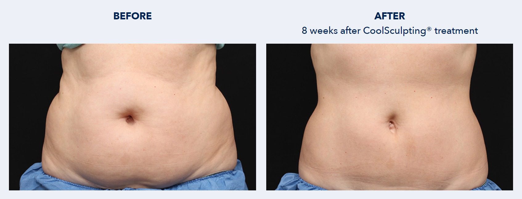 CoolSculpting Before and After Patient Results 2