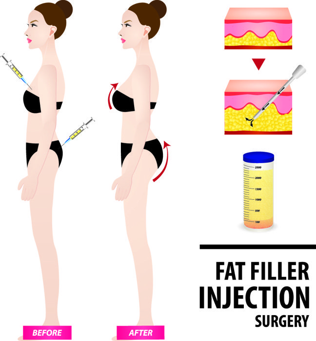 Illustration: Fat injection surgery