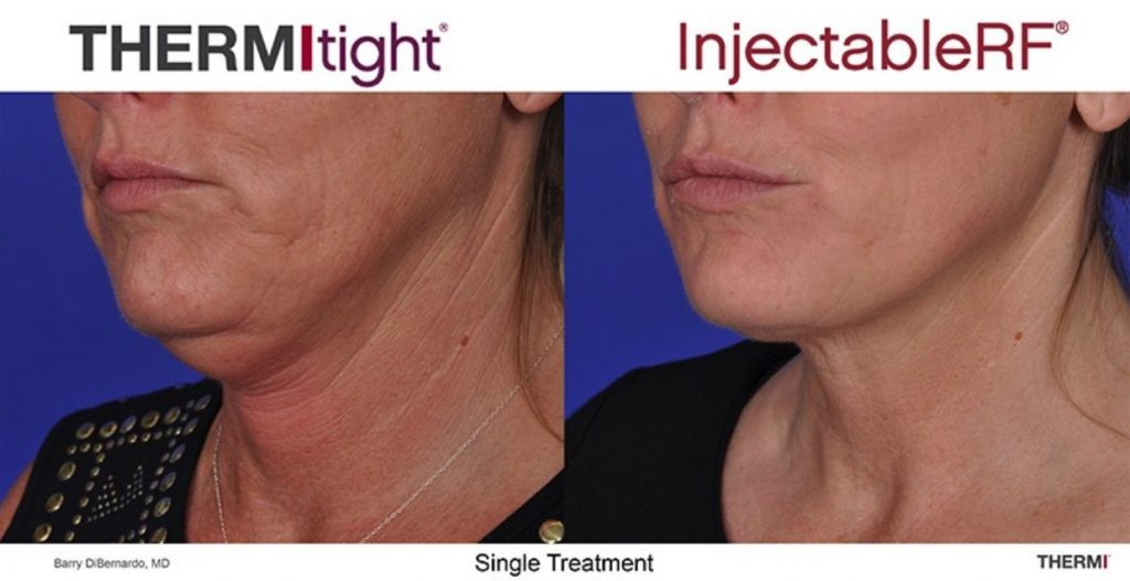 ThermiTight neck lift Before and After