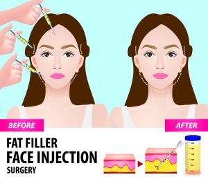 Infographic: Facial Fat Transfer