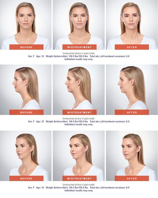 Kybella treatment. Showing before and after: front view, oblique view, side profile view