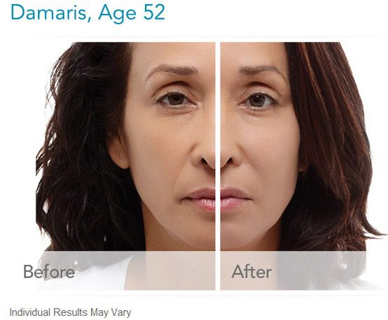52 years old woman before and after Radiesse treatment