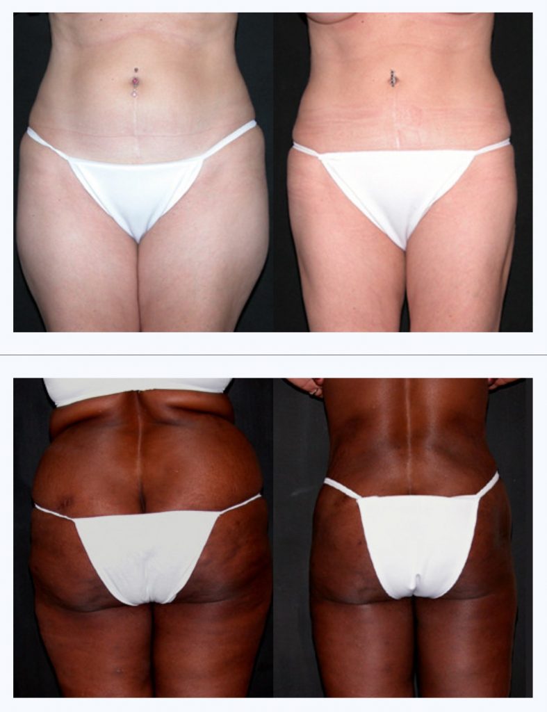 Liposuction Before & After Photos, Orlando Florida