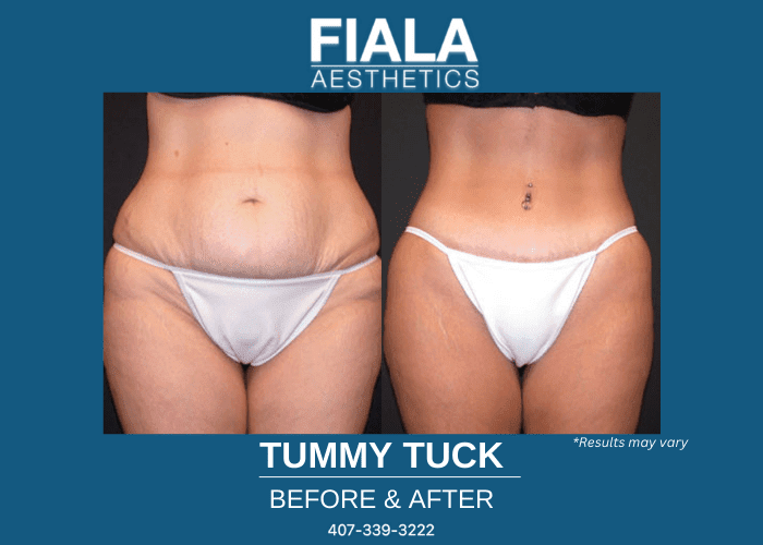 Before and after image of a tummy tuck performed in Orlando, Florida.