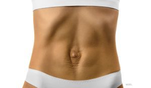 Close-up of woman's abdomen with diastasis recti.
