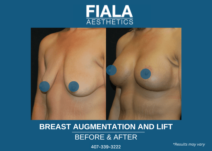 Breast lift and augmentation before and after image showing results in Altamonte Springs, FL.