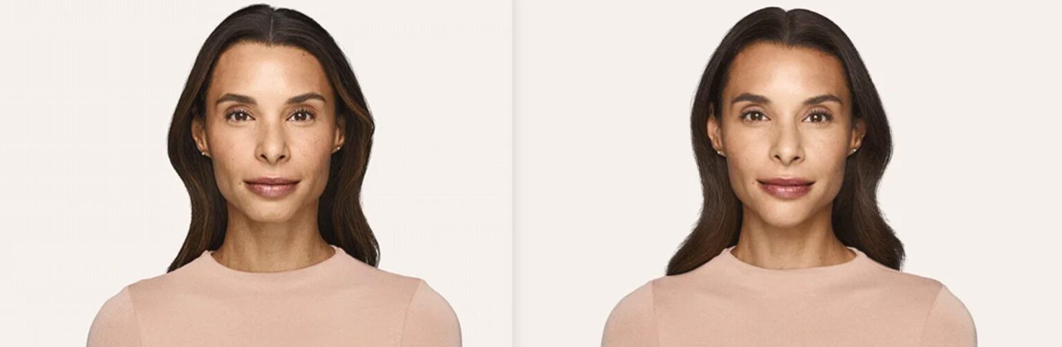 How Much Does Juvederm Volux Cost? Jaw Line Dermal Filler Orlando, FL