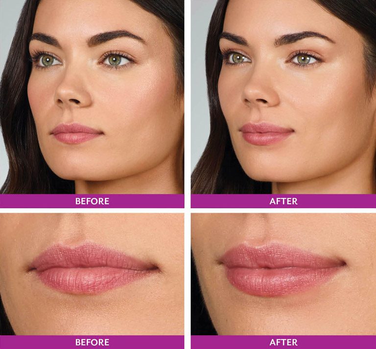 Juvederm Volbella dermal filler lip enhancement before and after photos Orlando FL Med Spa